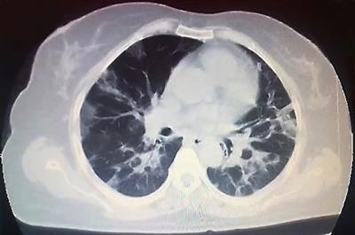 Case Report: Severe COVID-19 Pneumonia in a Patient With Relapsed/Refractory Hodgkin’s Lymphoma